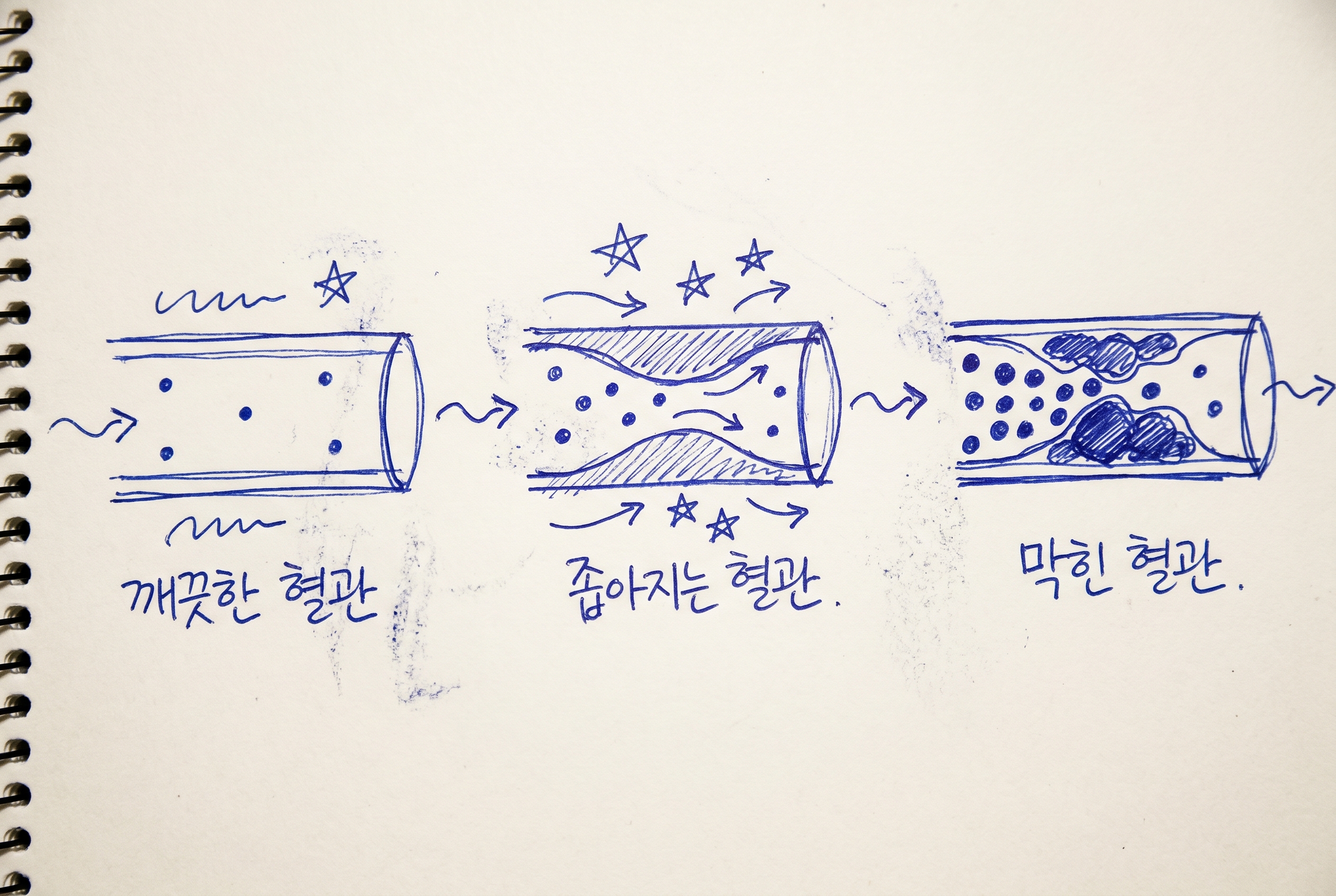 LDL이 혈관에 쌓이며 좁아지는 흐름을 보여주는 그림